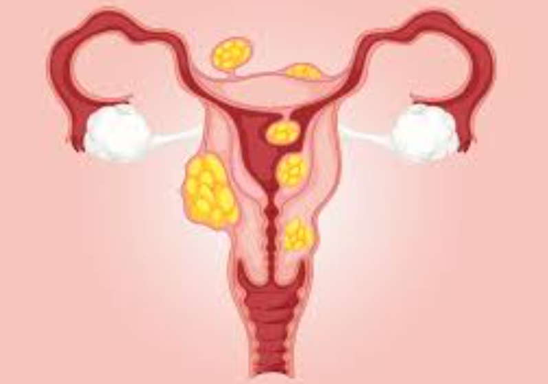 Fibroid Natural Womens Wellness